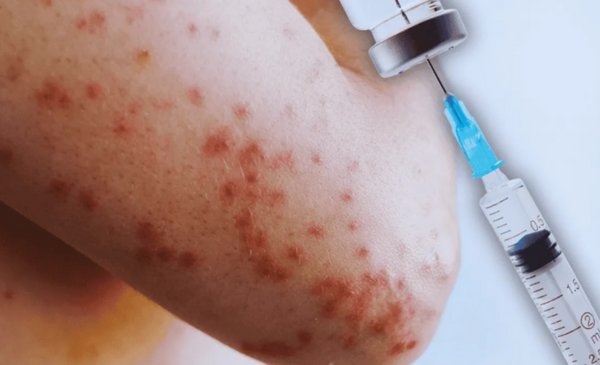 Salud llama a vacunarse y evitar aglomeraciones por brote de sarampión