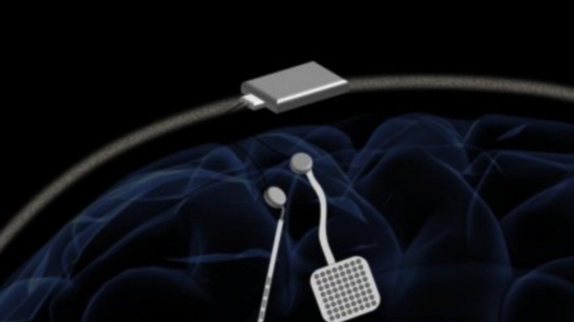 Un marcapasos para tratar el Parkinson y la epilepsia